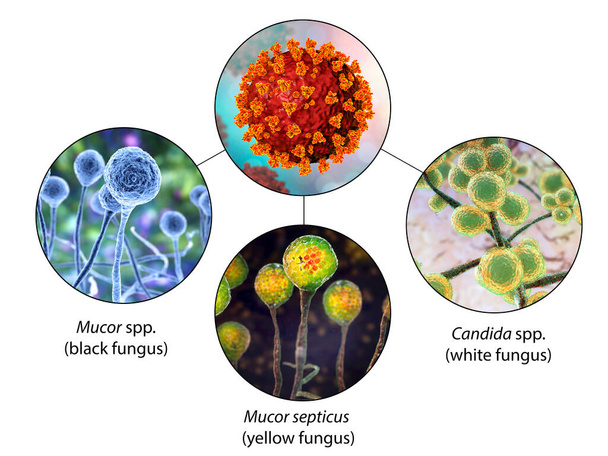 Pilzkomplikationen von Covid-19, 3D-Illustration. Covid-19-assoziierte Mykosen. Mucormykose (schwarzer Pilz), Candida (weißer Pilz), Mucor septicus (gelber Pilz). Etikettiertes Image - Foto, Bild