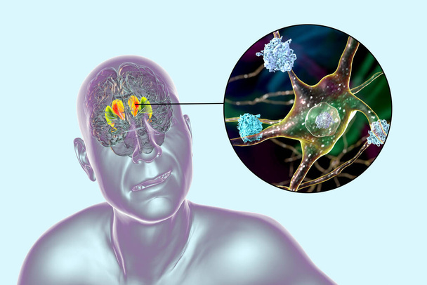 Dorsale Striatum, Caudatkern und Putamen, hervorgehoben im Gehirn einer Person mit Huntington-Krankheit und Nahaufnahme neuronaler Einschlüsse, konzeptionelle 3D-Illustration - Foto, Bild