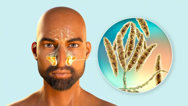 真菌フザリウムによる上顎鼻炎, 3Dイラスト.免疫不全患者における真菌性鼻炎 - 写真・画像