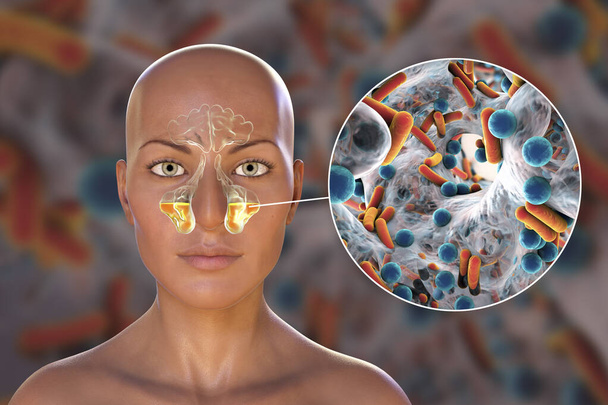 Sinusitis, Entzündung der Nasennebenhöhlen. 3D-Illustration zur Entzündung der Kieferhöhlen bei einer weiblichen Person und Nahaufnahme von Bakterien, die Sinusitis verursachen - Foto, Bild