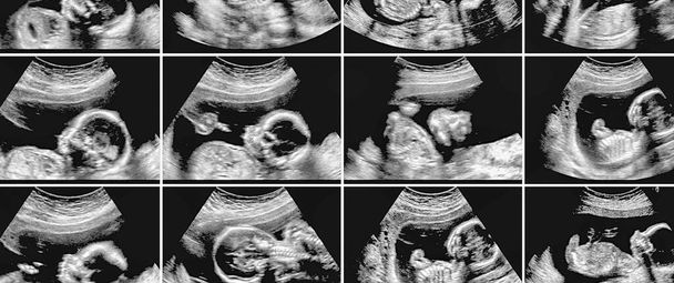Colagem de 16 imagens de fetos de ultrassonografia
. - Foto, Imagem