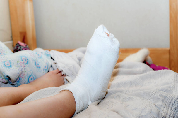 The girl has a broken leg. Woman resting at home in bed after medical treatment. Human leg in a cast on the bed. - Photo, Image