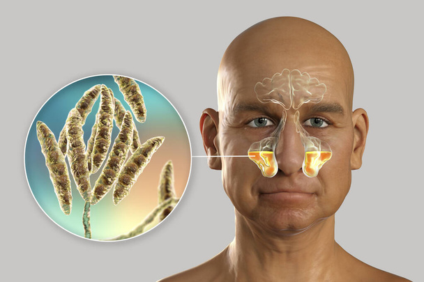 Kieferrhinosinusitis durch Pilze Fusarium, 3D-Illustration. Pilzliche Rhinosinusitis bei immungeschwächten Patienten - Foto, Bild