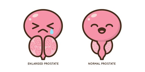 Cartoon benigní a vektorové ilustrace prostaty. Ikona charakter mužské urologie zánětlivé onemocnění. Plochý návrh diagramu, článek v lékařském časopise. Prostatitida, zvětšená, obstrukce, hypertrofie - Vektor, obrázek