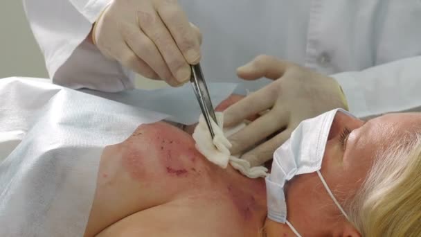 Notarzt desinfiziert und behandelt verbrannte Hautwunden im Brustbereich. Chirurgenteam bei der Behandlung von Verbrennungen an der Brust. Medizinisches Personal, das die Wunde mit mit mit Lösung benetzten Baumwollkissen entschärft. 4 k - Filmmaterial, Video