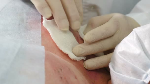 Dokter desinfecteren en behandelen van verbrande huid wond op borst gebied in noodgevallen. Chirurg team werkt met brandende huid op de borst. Medische werker debriding wond met katoen pads bevochtigd met oplossing. 4 km - Video