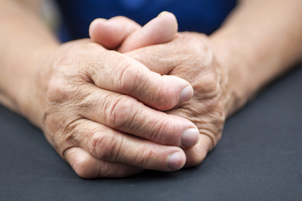 Las manos de la mujer deformada de la artritis reumatoide
 - Foto, Imagen