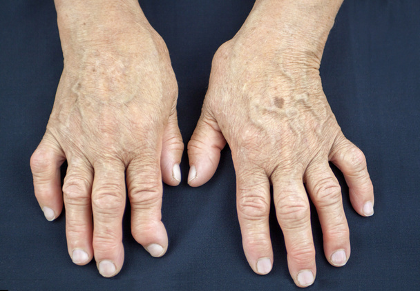 ruce ženy, deformované od revmatoidní artritidy - Fotografie, Obrázek