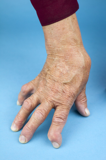 Mano de mujer deformada de artritis reumatoide
 - Foto, Imagen