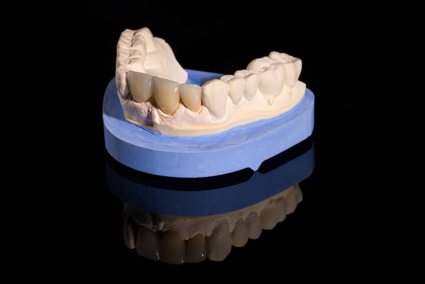 Gros plan de la dentition artificielle sur une empreinte dentaire rady pour une utilisation - Photo, image