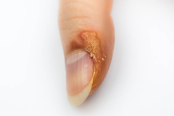 Lähikuva Syylä sormella. Tarttuva ihosairaus naisen kädessä. Lääketieteellinen hoito, makrokuva. - Valokuva, kuva