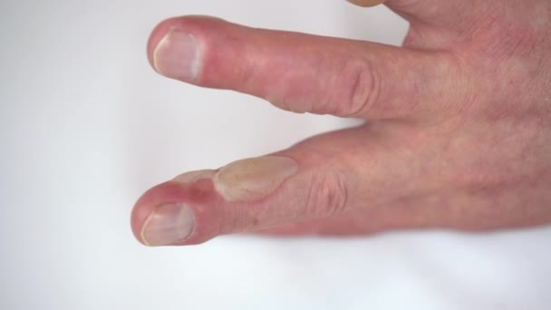 Close-up - branden van een mensenhand met heet water van de tweede graad. De huid is gezwollen met blaren. - Video