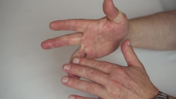 Un uomo ha spalmato un unguento sulla mano con una bruciatura d'acqua calda di secondo grado. La pelle è gonfia di vesciche. - Filmati, video