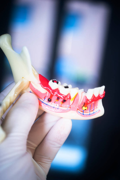 Karies Zahnärzte Zahnmodell von Zähnen, Zahnfleisch und Wurzelkanal - Foto, Bild