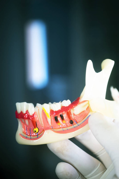 Dentistes carie dentaire modèle dentaire des dents, des gencives et du canal radiculaire - Photo, image