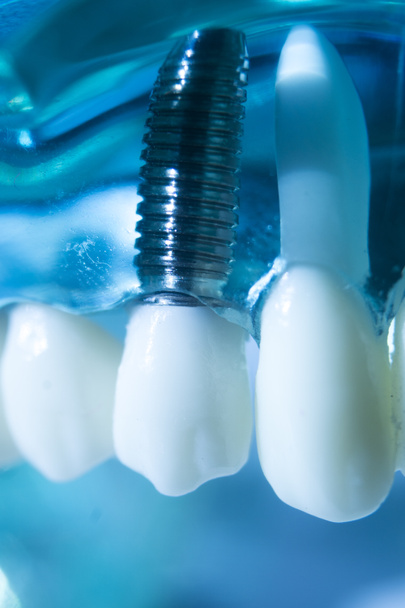 Tandheelkundig metaal implantaat tandheelkunde onderwijs model tonen tanden en tandvlees. - Foto, afbeelding
