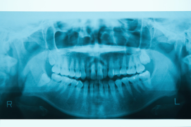 Dentalpanorama-Röntgenbild für Kieferorthopädie und Kieferorthopädie - Foto, Bild