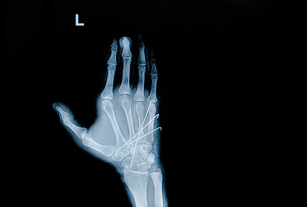 Film x-ray of hand fracture : show fracture metacarpal bone inse - Photo, Image