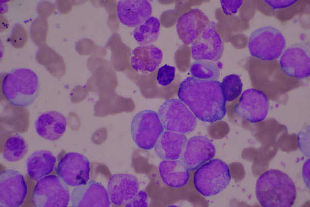 Éretlen és érett fehérvérsejtek.Szegmentált neutrofil, blasztos sejtek myelocyta, metamyelocyta, Band forma. - Fotó, kép