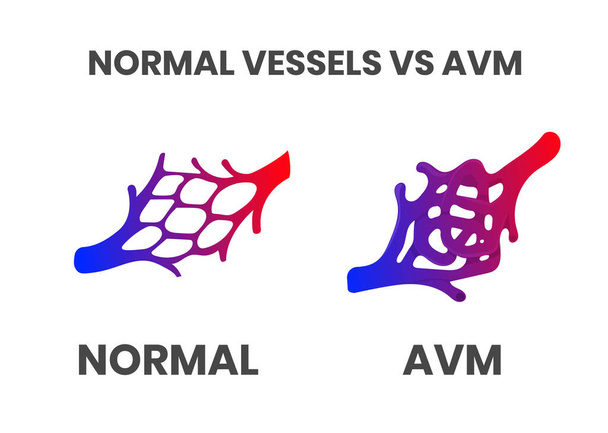 通常船と動静脈奇形(avm)ベクトル図 - ベクター画像