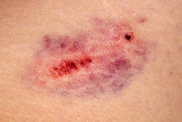 Κοντινό πλάνο στη μελανιά στο δέρμα του ποδιού μιας τραυματισμένης γυναίκας. Κοντινό πλάνο σε μελανιά στο δέρμα του ποδιού μιας τραυματισμένης γυναίκας. Έννοια της βίας φύλου. - Φωτογραφία, εικόνα