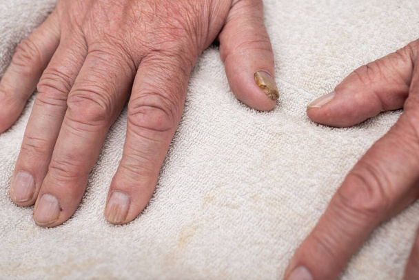 Infecção por fungos nas unhas no dedo grande. Infecção fúngica nas unhas mão, dedo com onicomicose.. - Foto, Imagem