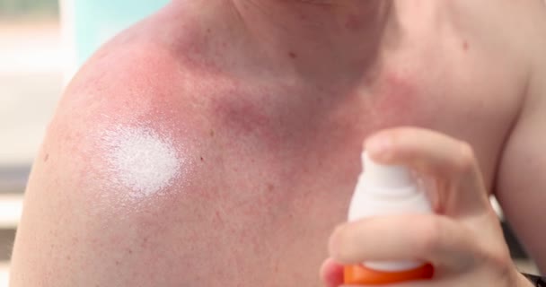 Hombre aplicando crema hidratante a la piel irritada roja primer plano película 4k - Imágenes, Vídeo