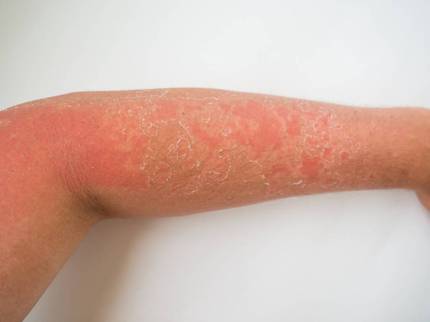 Sonnenbrand auf der Haut, starke Bräune am Arm - Foto, Bild