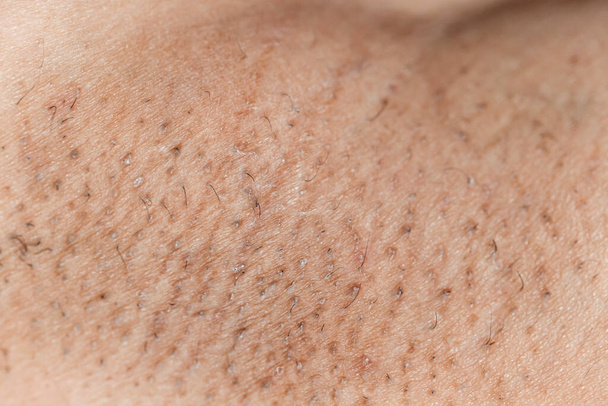 Mujer asiática teniendo problemas de piel con axilas negras - Foto, Imagen