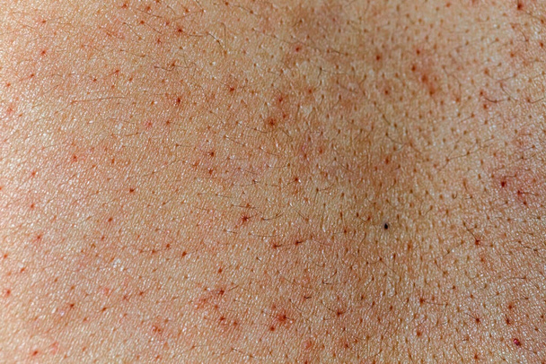Pores de peau problématiques de la femme et taches sombres sur le visage - Photo, image