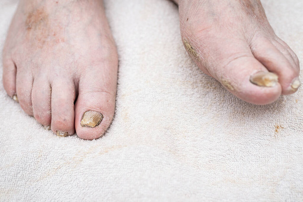 Infección por hongos en las uñas del pie del hombre.Fondo blanco, tiro en el interior. - Foto, imagen