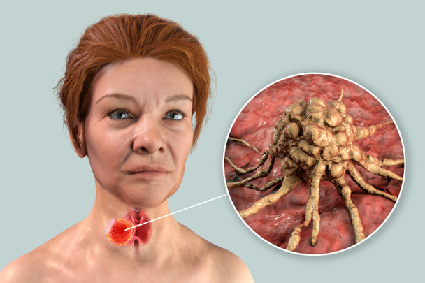 Καρκίνος του θυρεοειδούς. 3D απεικόνιση που δείχνει θυρεοειδή αδένα με όγκο μέσα στο ανθρώπινο σώμα και κοντινή προβολή των κυττάρων του καρκίνου του θυρεοειδούς - Φωτογραφία, εικόνα