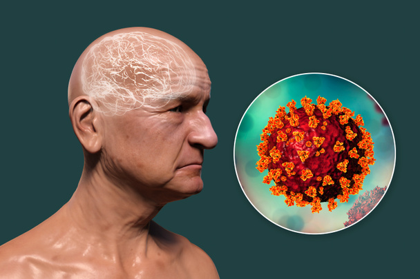 Covid-19 és demencia. A Covid-19 neuropszichiátriai következményei. 3D illusztráció. A demencia fertőző etiológiája. Koronavírusokkal fertőzött, progresszív agykárosodásban szenvedő idős személy - Fotó, kép