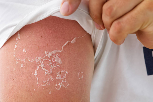 лущення шкіри після обпалення сонячним світлом. не використовуючи сонцезахисний крем
 - Фото, зображення