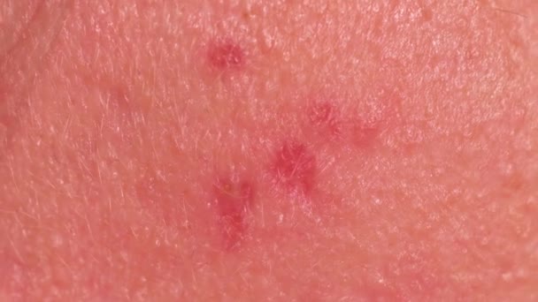 Probleemhuid van een meisje met vlekken en littekens na acne. Macrofotografie. - Video
