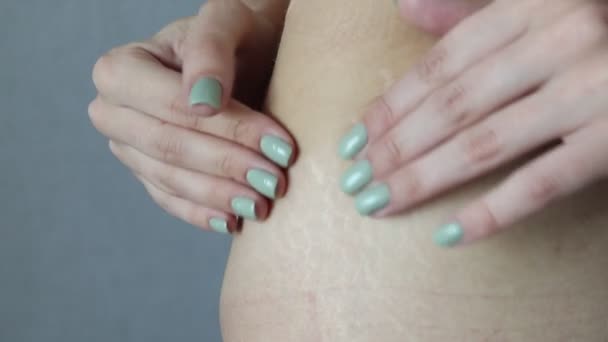 Egy nő mutatja a terhességi csíkjait a csípőjén.. - Felvétel, videó