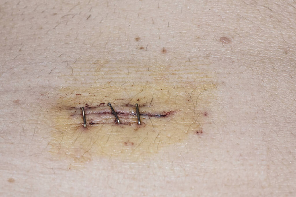 incisions chirurgicales dans l'abdomen après laparoscopie pour cholécystectomie fermé avec agrafes de suture éclairage flash - Photo, image