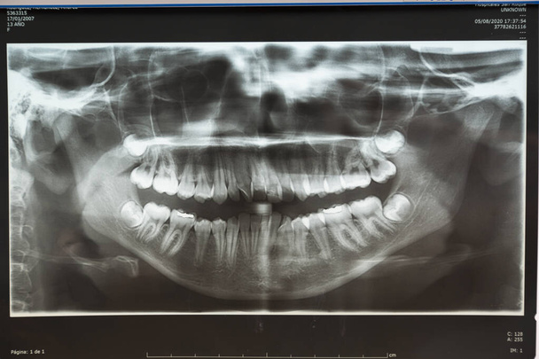 крупним планом рентгенівське зображення пацієнта
 - Фото, зображення