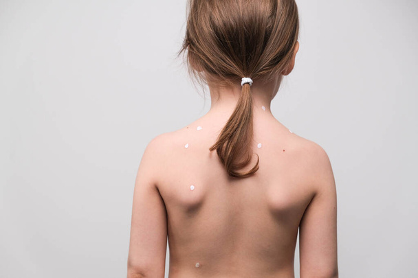 De rug van een klein meisje met waterpokken besmeurd met witte zalf op witte achtergrond - Foto, afbeelding