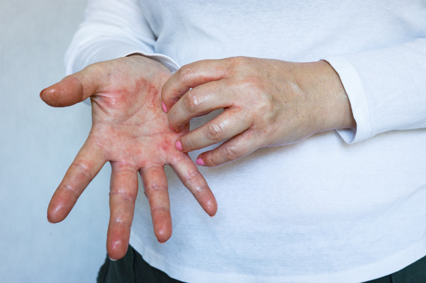 Pelle rossa screpolata con perdita di linfa, Mani graffianti donna con eczema, concetto di salute, sfondo luminoso  - Foto, immagini