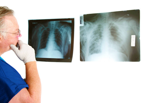 X線。医者はX線を調べる。白に隔離されてる。テキスト用の部屋。クリッピングパス。人間X線検査。胸部の医療用X線撮影。医師はcovid-19コロナウイルスに感染した肺の患者のX線を検査する。肺炎だ。人間のX線.  - 写真・画像