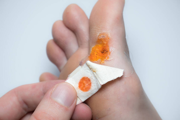 Malattia contagiosa della pelle a piedi. Foto trattamento medico - Foto, immagini