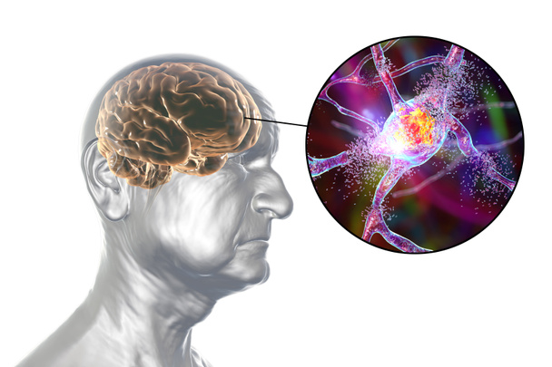 Bunama ve Alzheimer hastalığı tıbbi konsepti, 3 boyutlu illüstrasyon. Hafıza kaybı, beyin yaşlanmaları. Kavramsal görüntü, yaşlılıkta beyin fonksiyonlarında ilerleyen bir bozukluk olduğunu gösteriyor. Nörodejenerasyon - Fotoğraf, Görsel