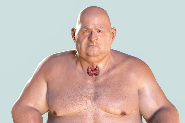 Pajzsmirigy kiemelt elhízott ember, 3D illusztráció. Fogalom az elhízás és a belső szervek betegség. Pajzsmirigy autoimmunitás és hypothyreosis. - Fotó, kép