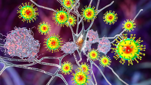 Инфекционная этиология слабоумия. Нейропсихиатрические сиквелы Ковида-19. Вирусы, поражающие нейроны и прогрессирующее нарушение функций мозга, амилоидные бляшки в тканях мозга. 3D иллюстрация - Фото, изображение