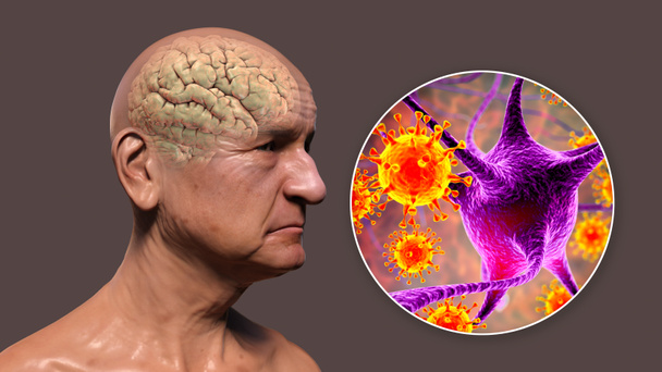 Infektionsetiologie der Demenz. Konzeptionelle 3D-Illustration, die einen älteren Menschen mit fortschreitender Beeinträchtigung der Hirnfunktionen, Amyloid-Plaques im Gehirn, zeigt. Viren, die Neuronen befallen. - Foto, Bild