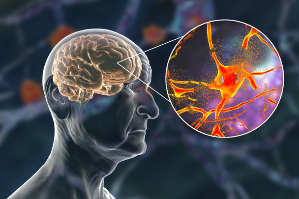Dementia ja Alzheimerin tauti lääketieteellinen käsite, 3D-kuvitus. Muistinmenetys, aivojen vanheneminen. Käsitteellinen kuva, joka osoittaa aivotoiminnan heikkenemistä iäkkäillä potilailla. Hermoston rappeutuminen - Valokuva, kuva