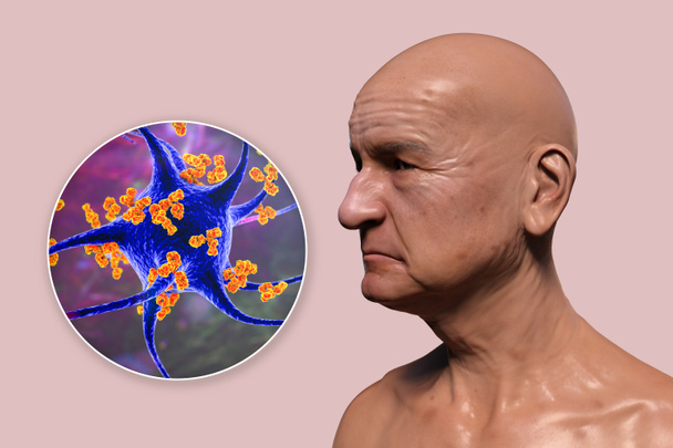 Anti-neuronal antibodies in neuredegenerative diseases and dementia. Conceptual 3D illustration showing an elderly person and close-up view of antibodies affecting neurons - Photo, Image