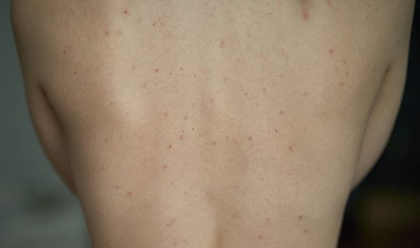 Feminino de volta com acne. Problemas de cuidados da pele. Rapariga com alergia na pele. Conceito de dermatologia - Foto, Imagem