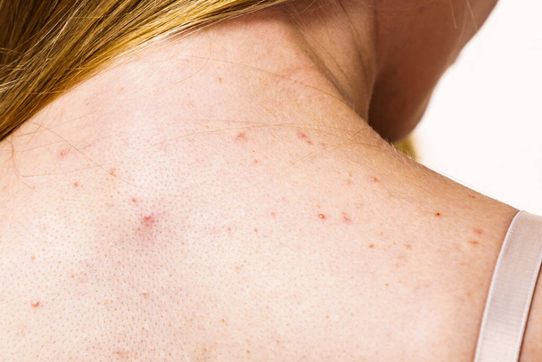 Health problem, skin diseases. Young woman showing her back with acne, red spots. Teen girl with many pimples. - Foto, imagen